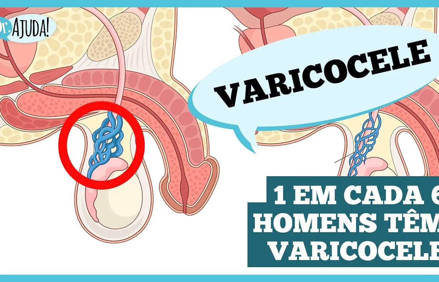Varicocele: o que é importante saber?