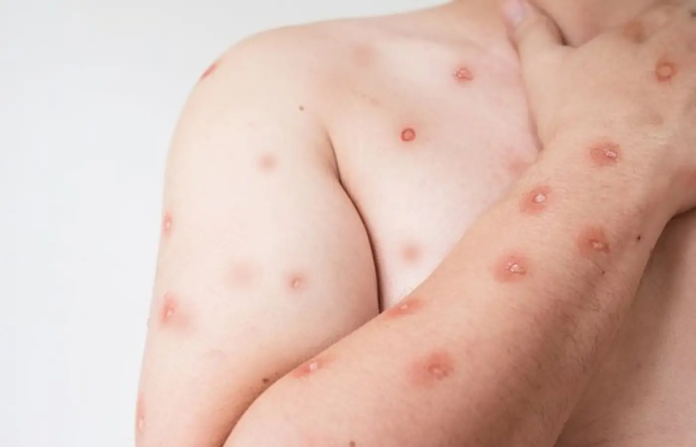 pele e aids.pmd, image size:1400x900