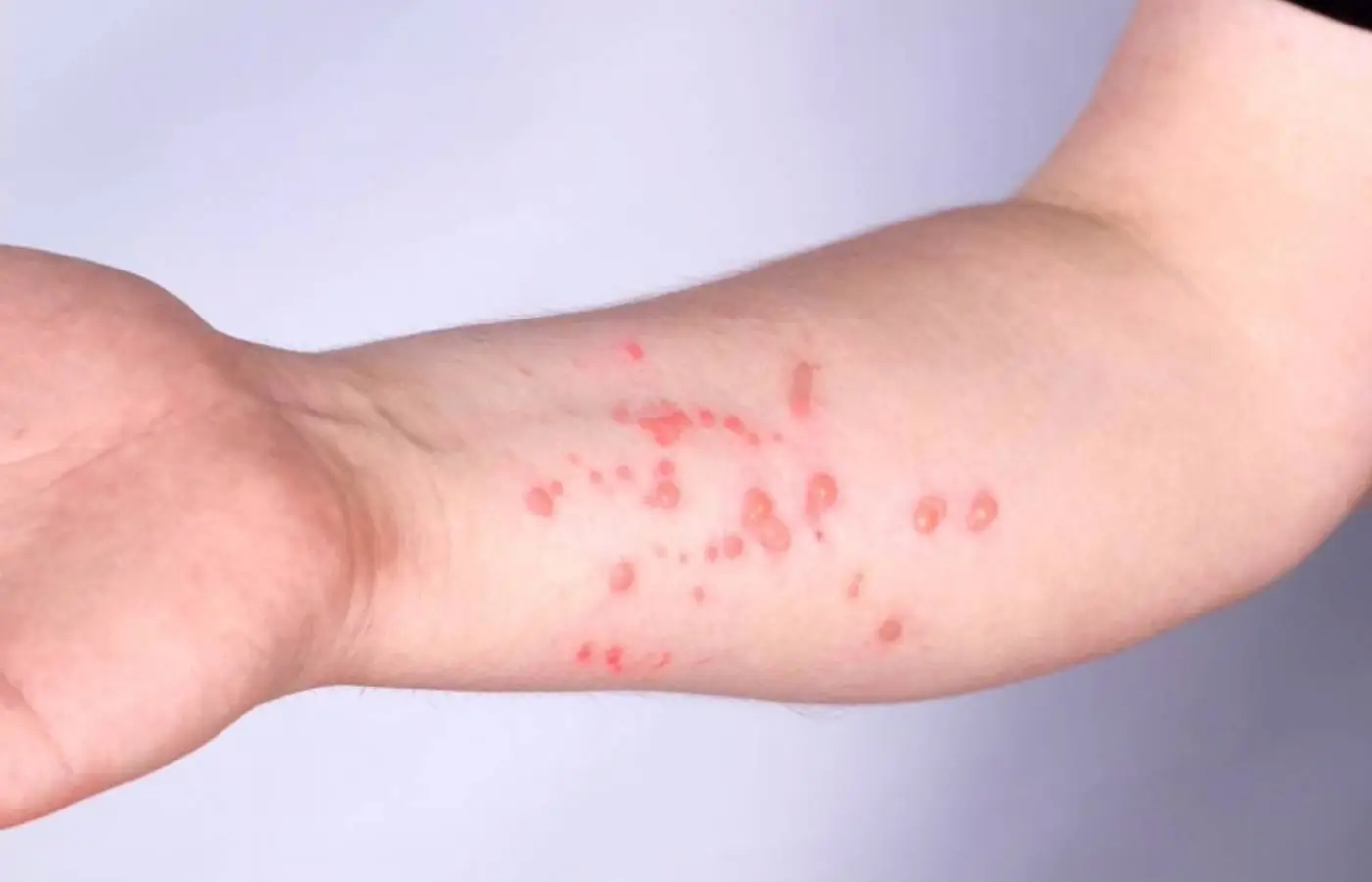 Mpox: Brasil registra 140 casos em 2026