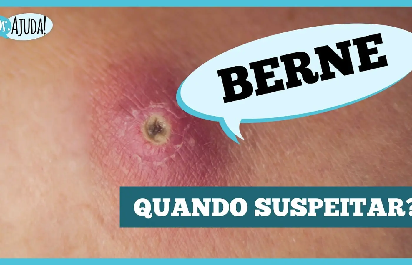 Berne: parece uma espinha, mas pode ser uma larva na pele