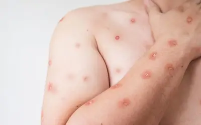 Foto: Ministério da Saúde/divulgação