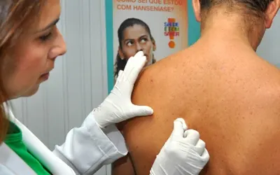 Hanseníase tem cura e o tratamento é feito pelo SUS. Foto: Divulgação/Semsa