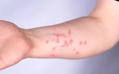 Foto: Mpox/Getty Images