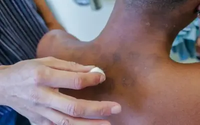 A hanseníase tem cura e é tratada pela rede do SUS. Foto: Reprodução/Secretaria Municipal de Saúde de Mesquita (RJ)