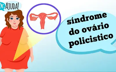 Síndrome do Ovário Policístico. Foto: Reprodução/Canal Doutor Ajuda